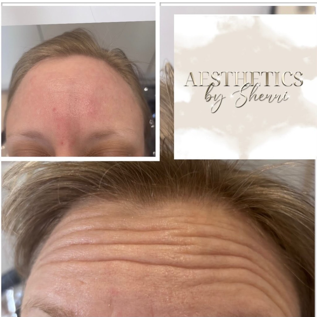 Anti-Wrinkle Treatments
